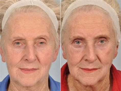 What Is A Good Age For Getting Droopy Eyelid Surgery Blepharoplasty