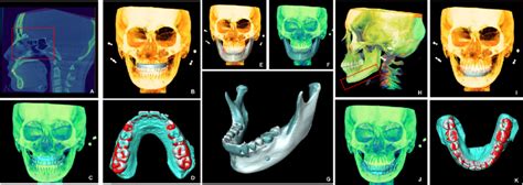 Superimposition Of The Digital Model Integrated Maxillofacial Cone Beam Download Scientific