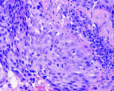 Squamous Cell Carcinoma Of The Cervix Nonkeratinizing Carcinoma Download Scientific Diagram