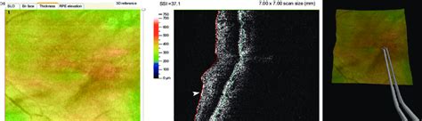 Left Panel Posterior Pole Image Of An Eye With Epiretinal Membrane And Download High