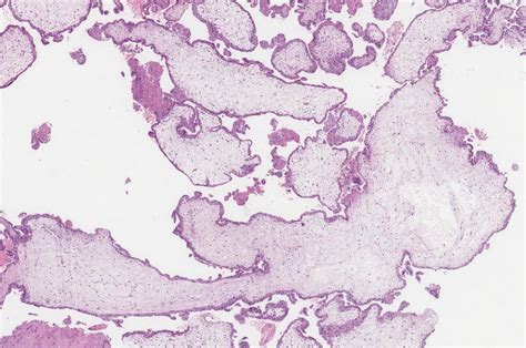 Pathology Outlines Partial Hydatidiform Mole