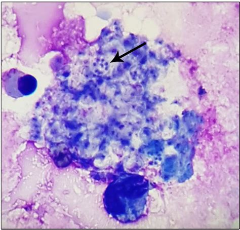 Scielo Brasil Pneumocystis Jirovecii Pneumonia In A Patient With Hiv Infection Complex