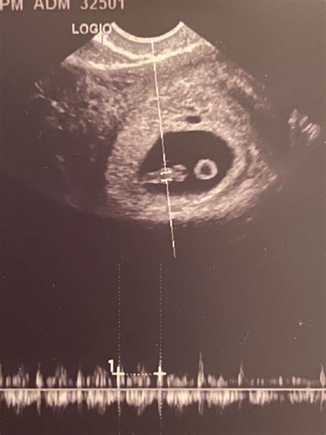 Weeks Ultrasound July Babies Forums What To Expect