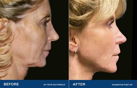 Renuvion Fda Cleared Minimally Invasive Hour Neck Procedure