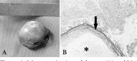 Figure 1 From Dermoid Cyst Of The Oral Cavity A Case Report