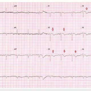 Ecg Ecg Showed Sinus Rhythm With T Wave Inversions In V To V