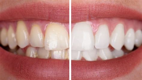 Tooth Discoloration Causes Treatment Prevention