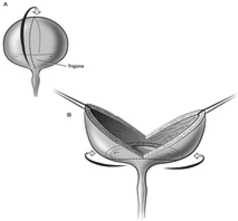 Simple Cystectomy Outcomes Of A New Operative Technique Urology