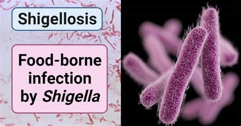 Foodborne Infection By Shigella Shigellosis Food Poisoning