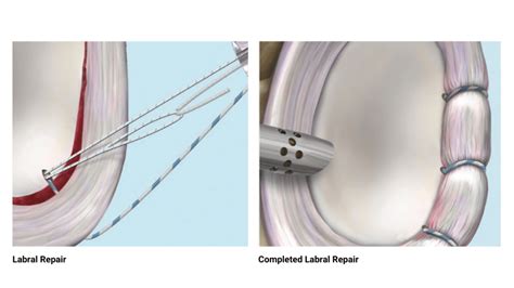 Posterior Labrum Repair Protocol