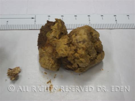 Gallstone Pictures Gallery See Images Of Real Gallstones Passed