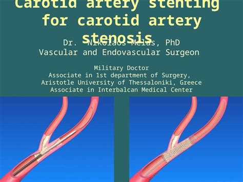 Ppt Carotid Artery Stenting For Carotid Artery Stenosis Dr Nikolaos Melas Phd Vascular And