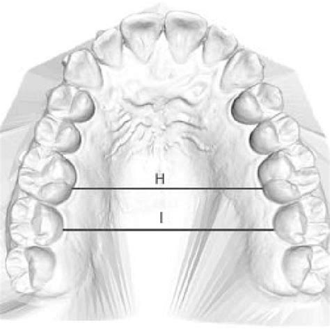 Pdf Maxillary Arch Development With Invisalign System Analysis Of