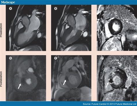 Advances Of Cardiovascular Mri In Hypertrophic Cardiomyopathy