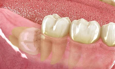 Terceros Molares O Muelas Del Juicio Red Dental Inprodent