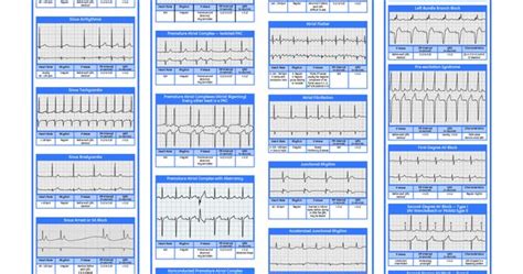 Acls Rhythm Identification Cheat Sheet