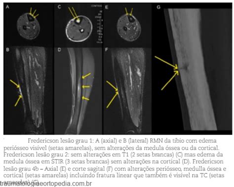 Classificação De Fredericson Traumatologia E Ortopedia