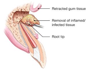 Apicoectomy Root End Surgery Elite Endodontics