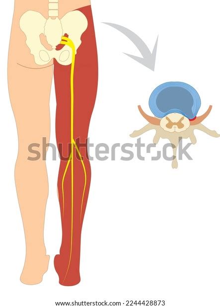 Sciatica Sciatic Nerve Pain Illustration Right Stock Vector (Royalty Free) 2244428873 | Shutterstock