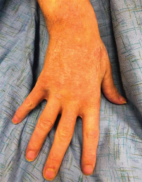 Scaly Plaques In A Malnourished Patient Cleveland Clinic Journal Of