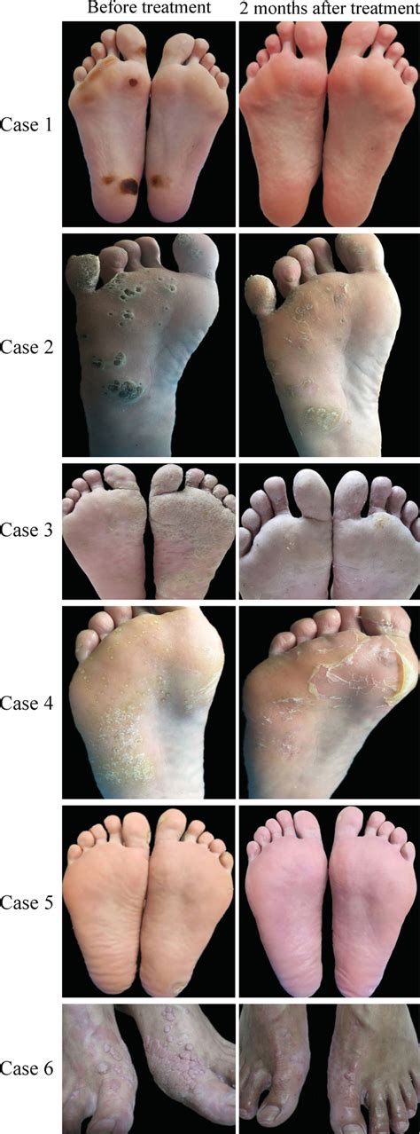 The patients with extensive/recalcitrant warts on the feet before and 2 ...