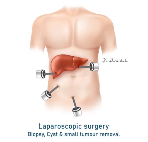 Best Liver Cancer Hospital In Ahmedabad India