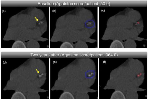 Progression of coronary artery calcification after radiation ...