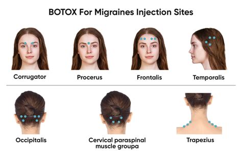 Botox For Tension Headaches Cosmetic Surgery Tips