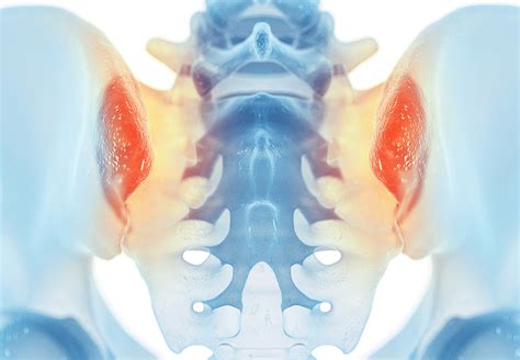 Sacroiliac Joint Inflammation