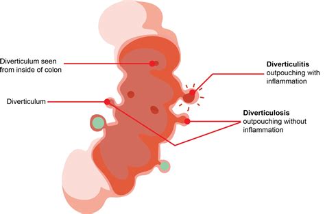 Diverticular Disease Colonoscopy Central Coast