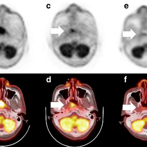 Axial ¹⁸F FDG PET and PET CT images in a 32 year old man with T3