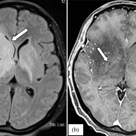 MRI Axial Sections T2 Weighted A And B Showing A Diffuse Edema Of