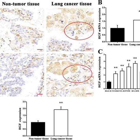 Expression Levels Of MiR 144 3p In Lung Cancer Tissues And Various Lung