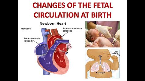 Changes Of The Fetal Circulation At Birth Youtube