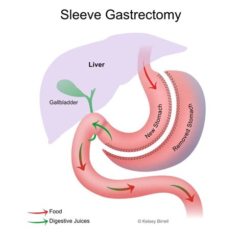 Sleeve Gastrectomy - Toowoomba Bariatric Surgery, South-East QLD