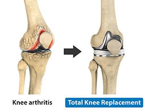 Stryker Total Knee Replacement Chandler, AZ | Knee Deformity Mesa ...