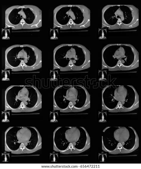 Computed Tomography Ct Scan Chest Abdomen Stock Photo Edit Now