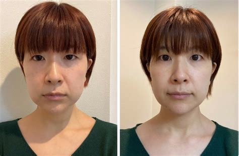 【40代の体当たり美容医療】顔のたるみを1ヶ月で解消！驚愕の小顔メソッド「カオレッチ」体験記 Story ストーリィ オフィシャルサイト