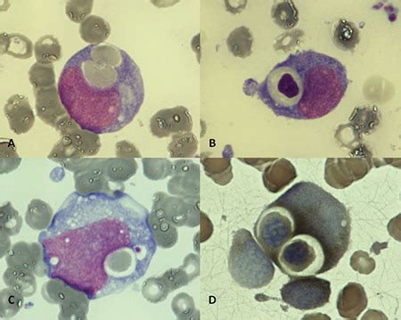 Acute Monoblastic Leukemia With Erythrophagocytosis And Absence Of