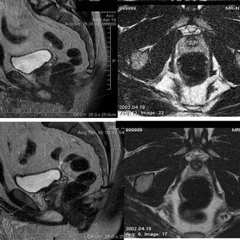 A Endorectal Coil And B T 2 Weighted Image Using The Endorectal Download Scientific Diagram