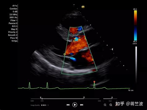 Fda 批准首个ai全自动心脏超声解决方案来测量 2d 和多普勒超声心动图 知乎