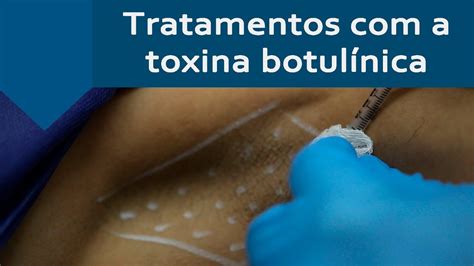 Tratamento Com A Toxina BotulÍnica E Suas Vantagens Youtube