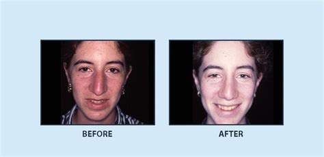 Rhinoplasty Before And After Dr Burt Greenberg Plastic Surgeon