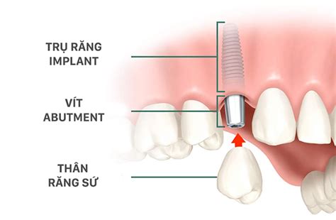 L I Ch V T Tr I Ch C Khi Tr Ng R Ng Implant Review Nha Khoa