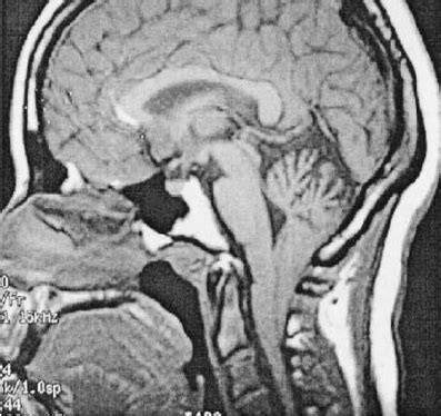 Brain MRI (coronal view — T2 weighted) opercular polymicrogyric cortex... | Download Scientific ...