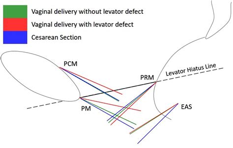 Pelvic Floor Structures Fiber Direction After Vaginal Birth As Seen On