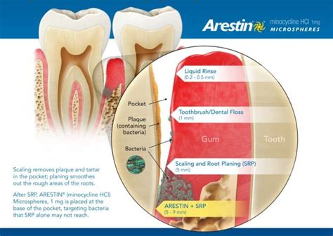 Antibiotic Treatments For Periodontal Disease In Jacksonville Fl