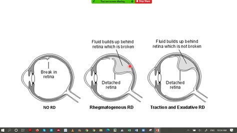 Retinal Detachments Pathophysiology Types Treatment Youtube