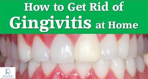 Gum Disease : Symptom, Causes, Home Remedies & Treatment » How To Relief