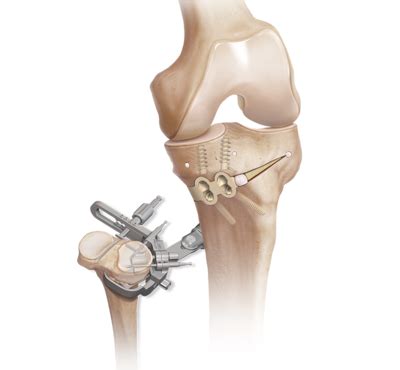 Arthrex IBalance HTO Implants And Anchors